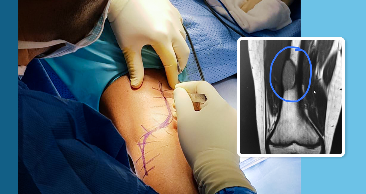 Bone tumor surgery with pre-operative markings and diagnostic imaging inset